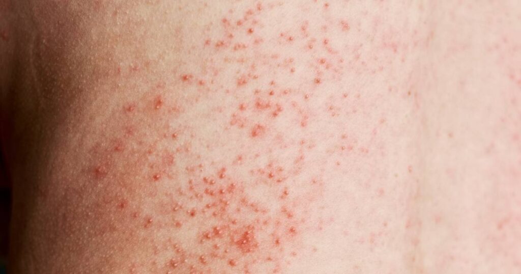 Skin Rashes